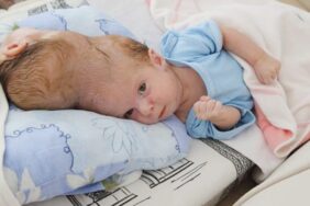 siyam_ikizleri_ayrilmak_icin_gun_sayiyor