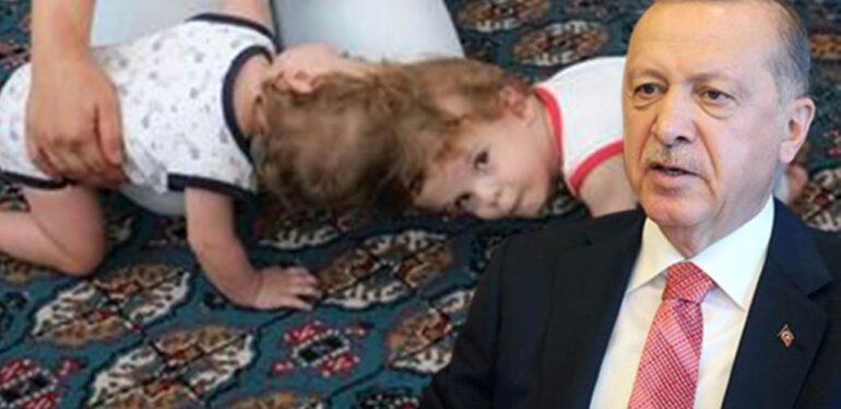 Mahmutlarlı yapışık ikizler ayrıldı