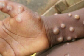 maymun-cicegi-virusu-yedi-ulkenin-a-YAHy_cover